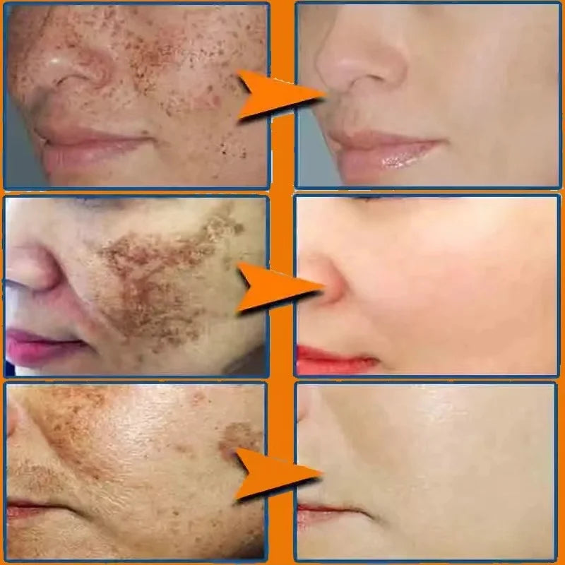 Whitening Serum Effective Remove Freckle Liquid Fade Melanin Fade Dark Spots Melasma Whiten Brighten Skin Care Products