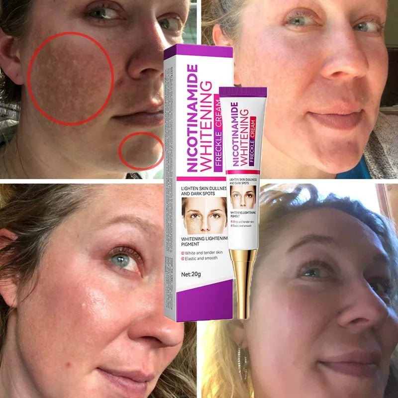 2024 Niacinamide Whitening Freckle Cream Effectively Remove Melasma Cream Lightens Black Spots Acne Marks Brightens Skin Care